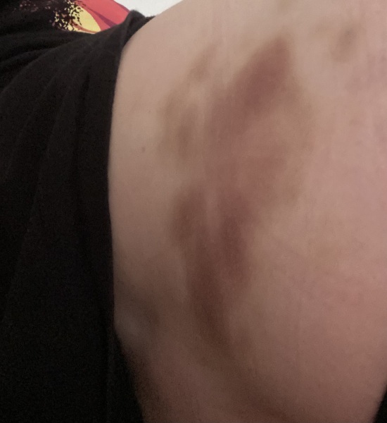 I’ve woken up to my right buttock being absolutely black and blue