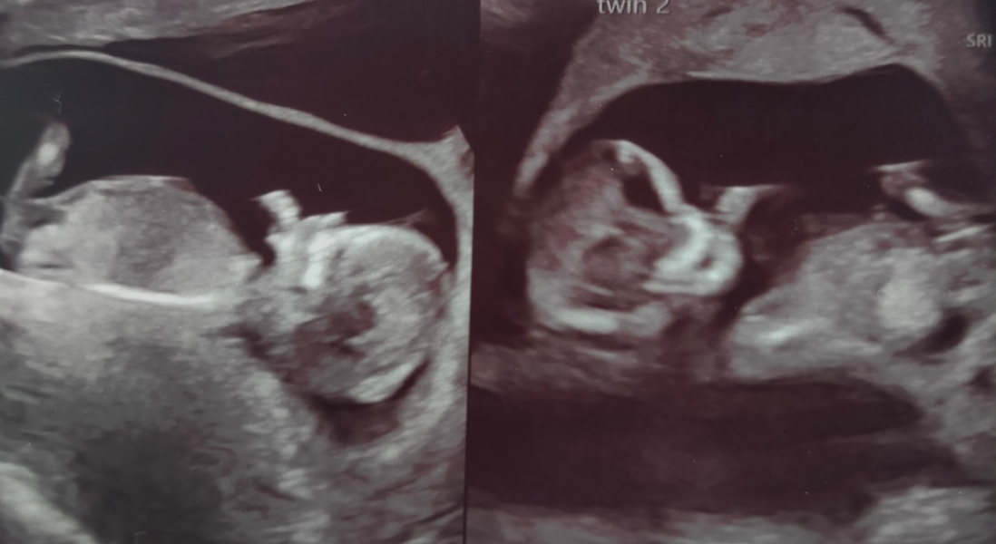 12 week scan gender theory suggestions 💗🤔💙
