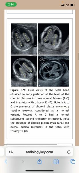 12 week scan - brain abnormality