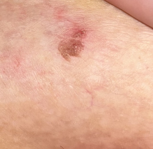 To ask if this is a mole?