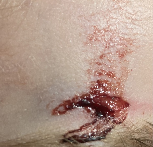 Cut on head (photo)