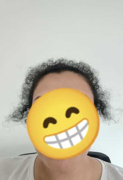 Very short hairs around fringe after pregnancy