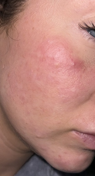 Need help with my hormonal skin at age 29?!