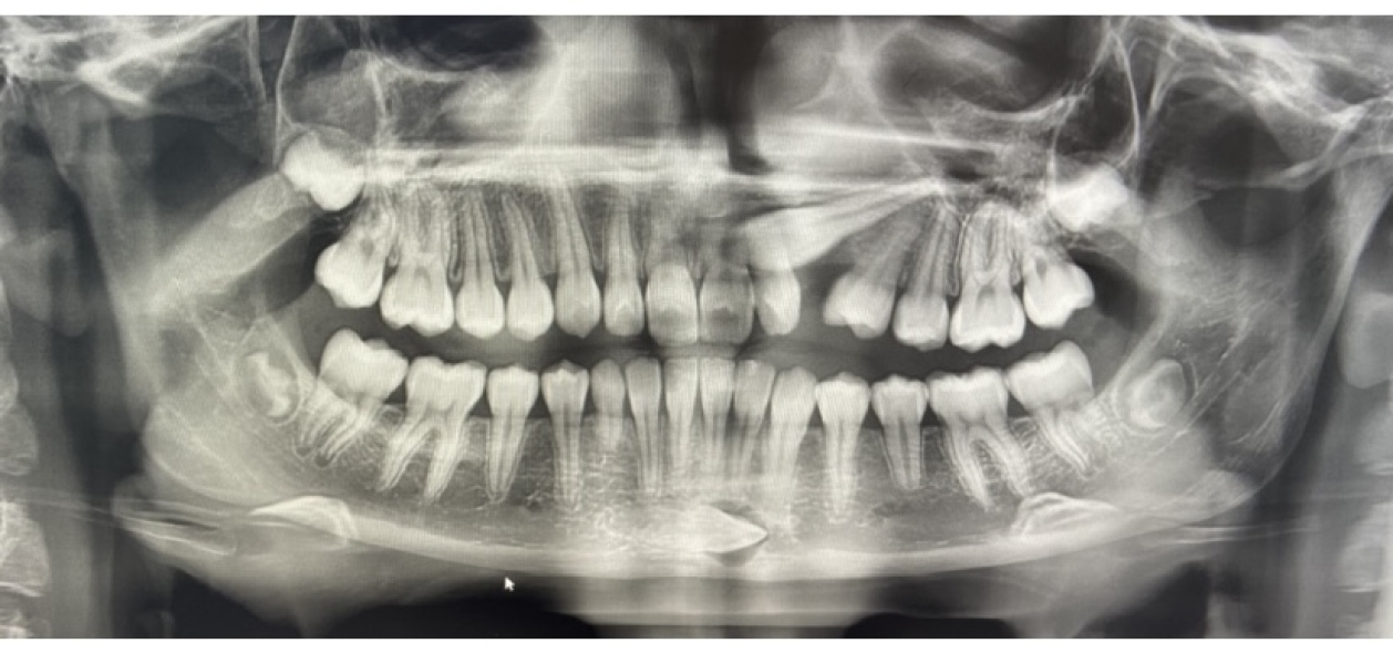 Impacted canines in teenager - too many choices?