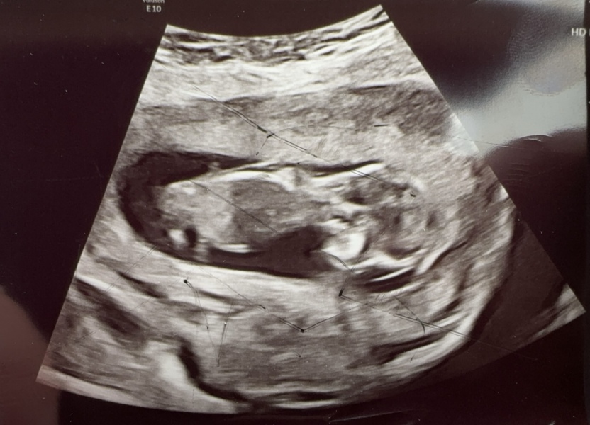 Boy or girl