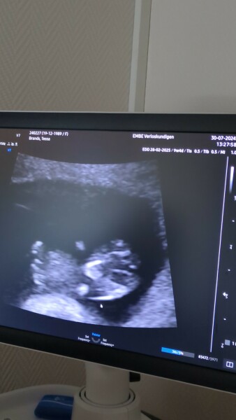 Nub at 9,5 weeks?