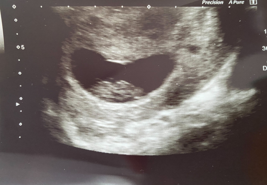 BFP after recent loss