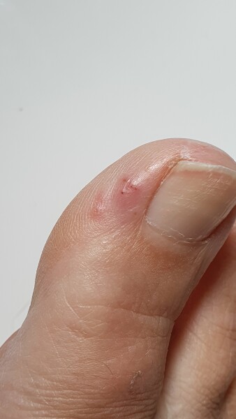 Athlete foot, ecxma or something else?