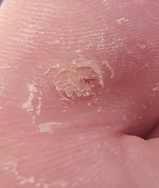 Is this a verruca still?? Picture attached