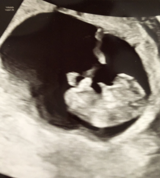 BFP after recent loss (Thread 2) 🌈