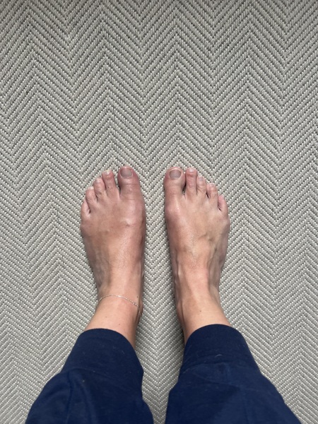 Bunion Keyhole surgery