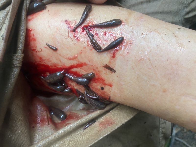 Attacked by Leeches- TMI Photos