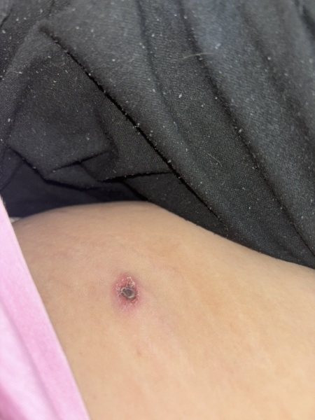 Thigh boil? Picture included