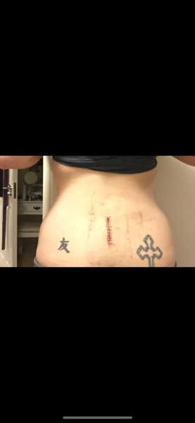 To ask if you’ve had a Microdiscectomy?