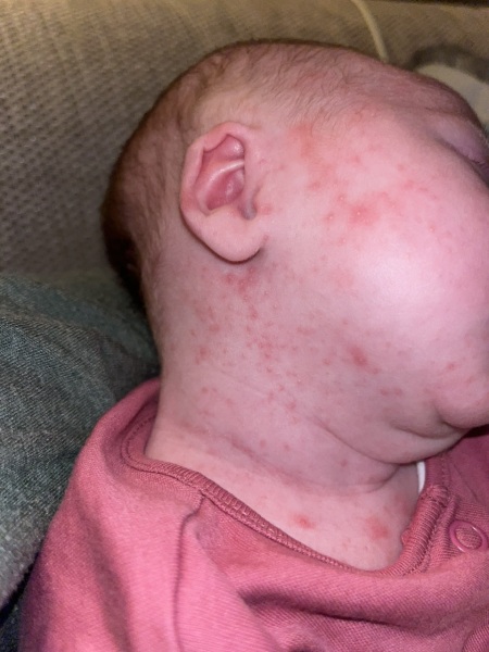 Is this more than baby acne / newborn rash