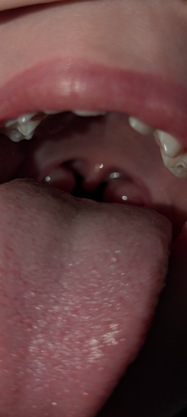 Are tonsils this big normal?