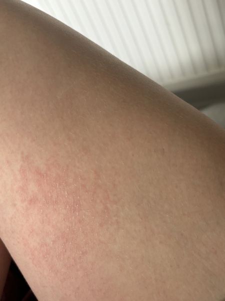 Rash inside leg