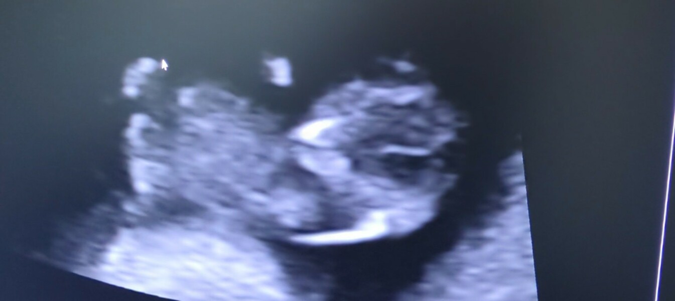 Nub at 9,5 weeks?