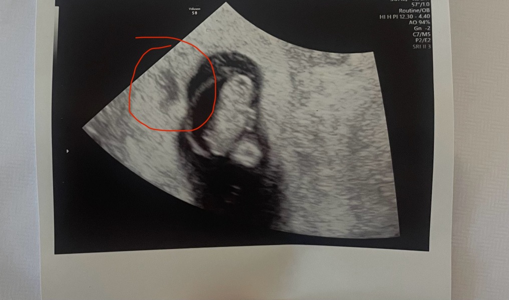 What is this on my 8 week scan photo?