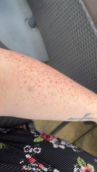 Bruising