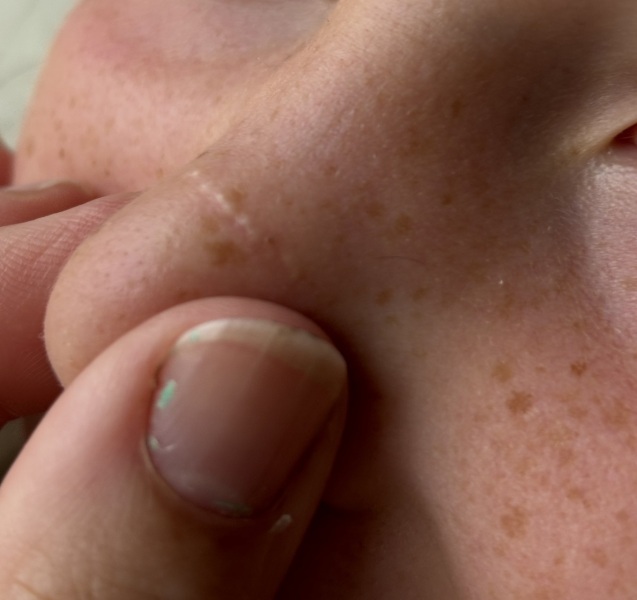 What is this line of whiteheads?