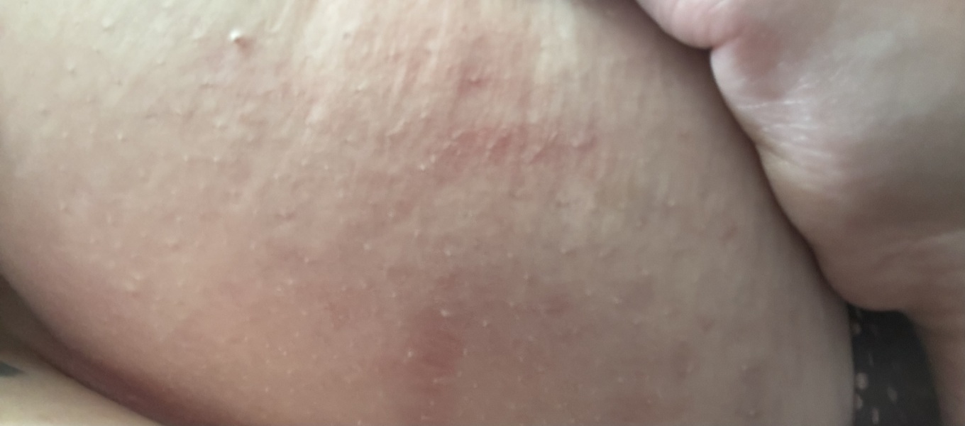 Dry rash on breast??