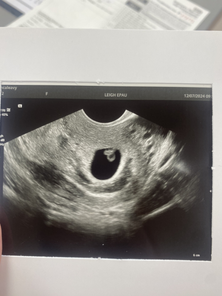 Really concerned and confused! Ectopic? Miscarriage?