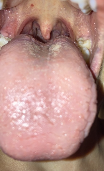 Anyone's tongue look like this?