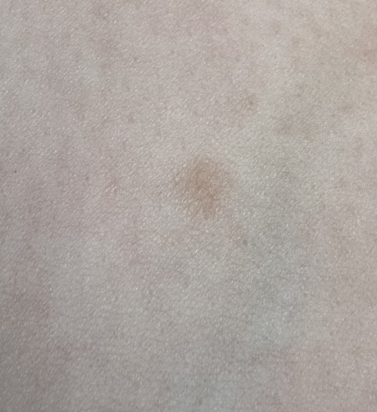 Does this mole look ok?