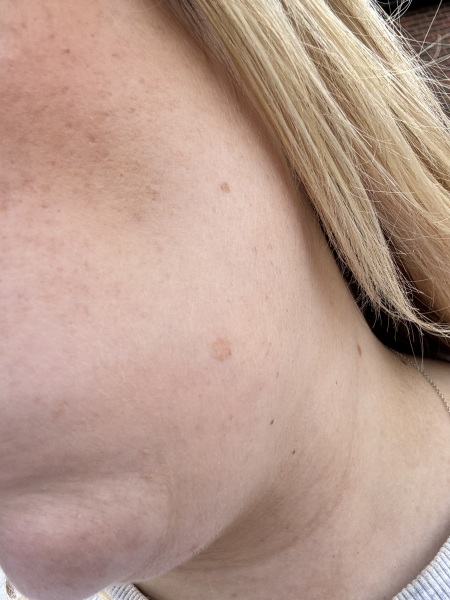 Melasma?