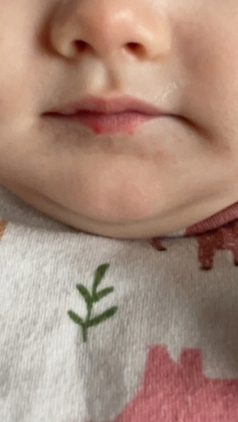 Red spots on baby’s lips??