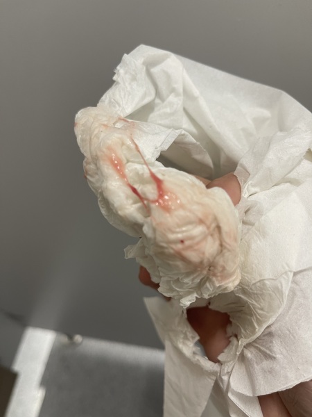 Implantation bleeding [Sensitive photo attached]