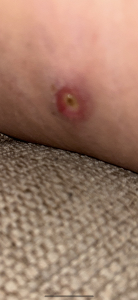 Thigh boil? Picture included