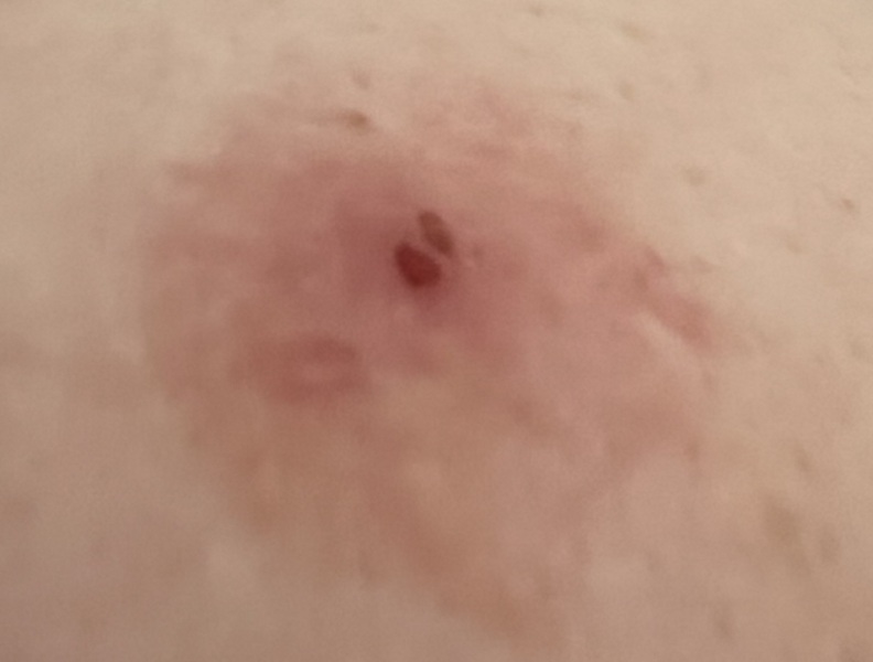 Sudocrem, salicylic acid or something else