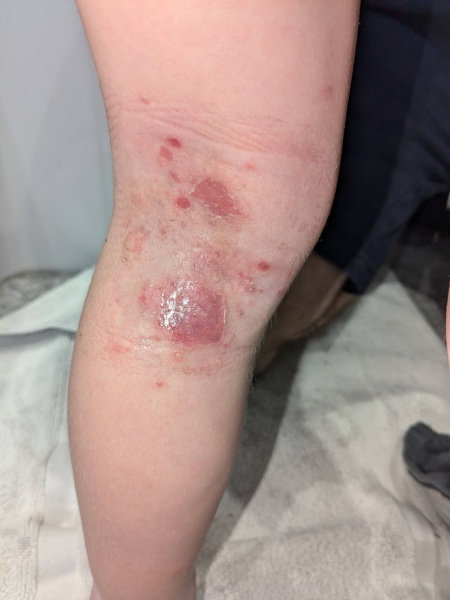 Infected bits getting worse?