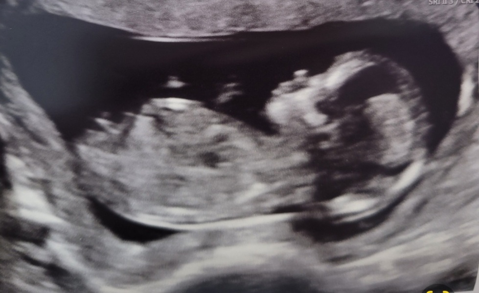 Boy or girl