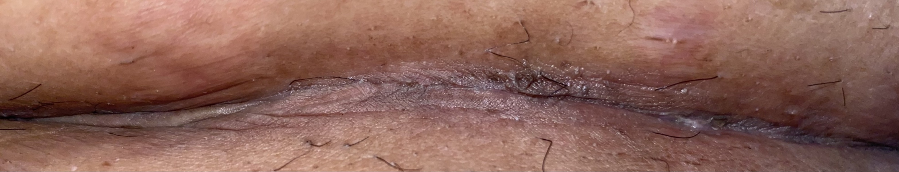 Csection wound opening infection