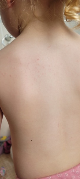 What is this on my toddler? Itchy?!