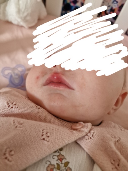 Strange lump in 7 month olds top lip.