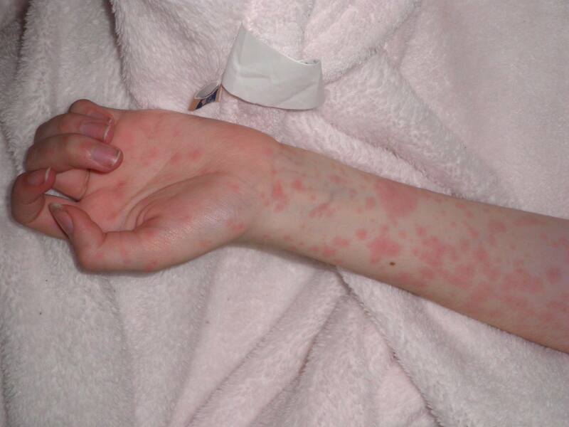 Does this look like chicken pox?