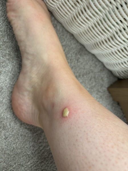what is this that has appeared on my leg ?