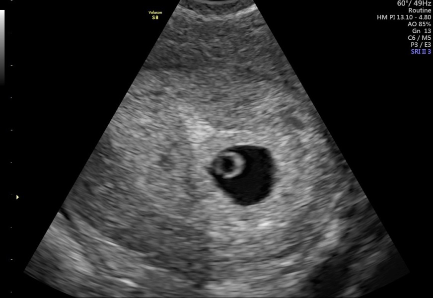 5 weeks 4 days scan!