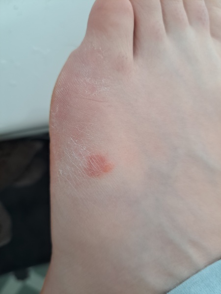 Patch of red skin on top/side of foot