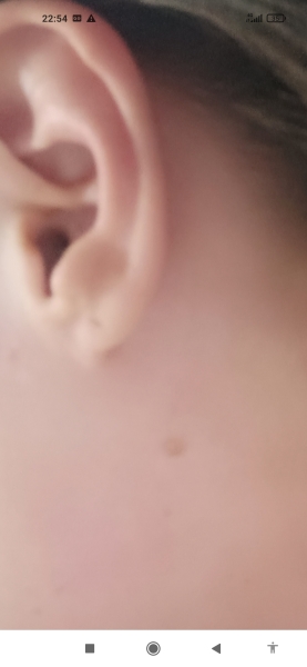 Skin cancer? Anxiety