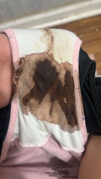 Implantation or early period??
