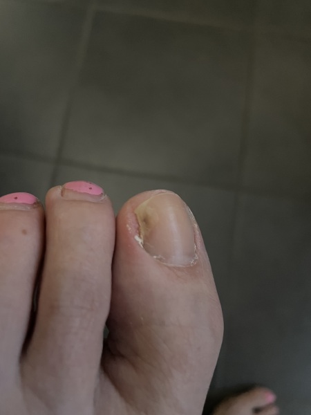 Mark on toenail