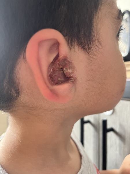 What is this?! DS’s poor ear…