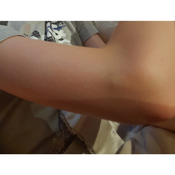 Lump on childs arm