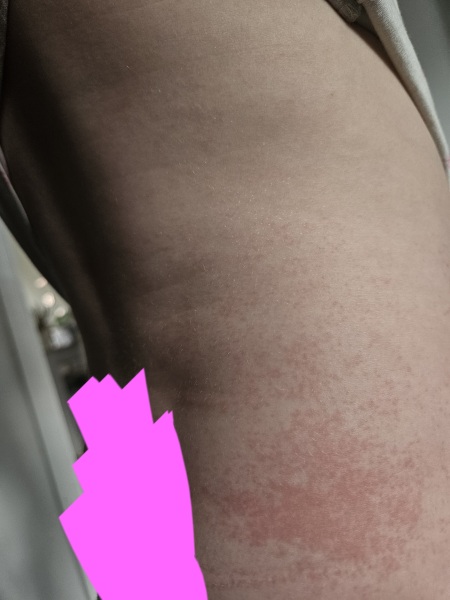 3 year old has a new rash today NO IDEA what it is?