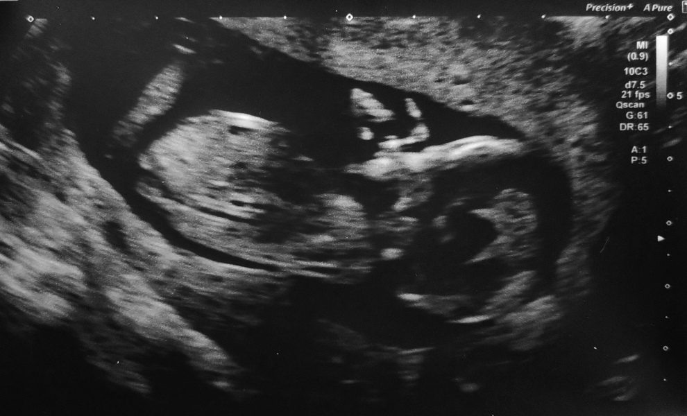 12 week ultrasound scan - what can we see?